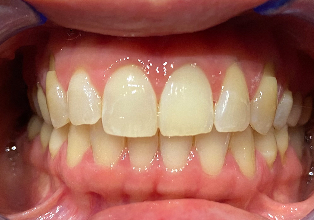 Sbiancamento-Endodontico-Dopo_-1