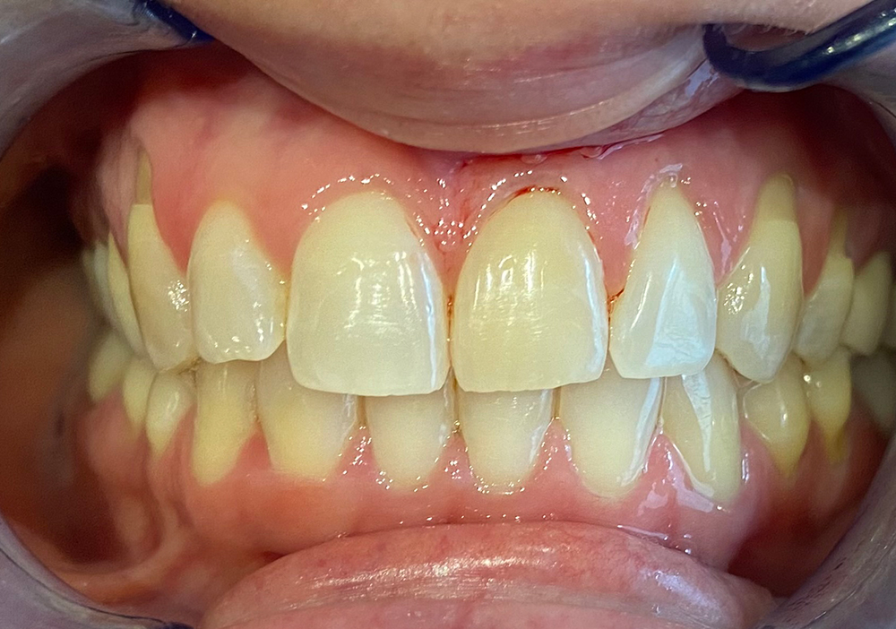 Sbiancamento-Endodontico-Prima__